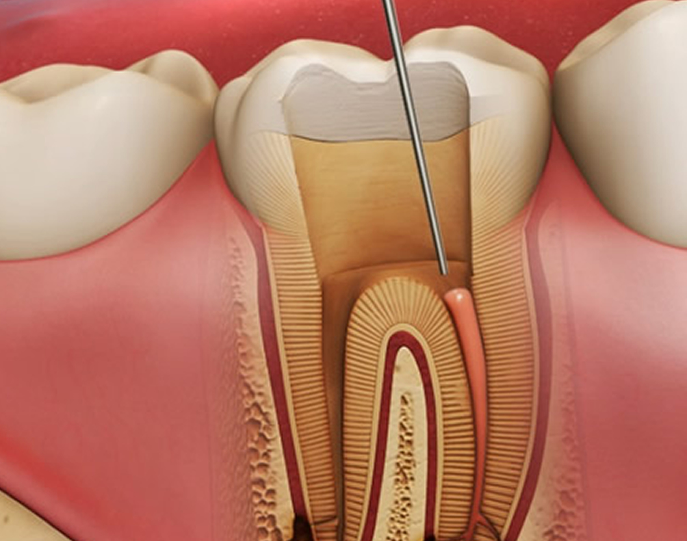 Endodonti